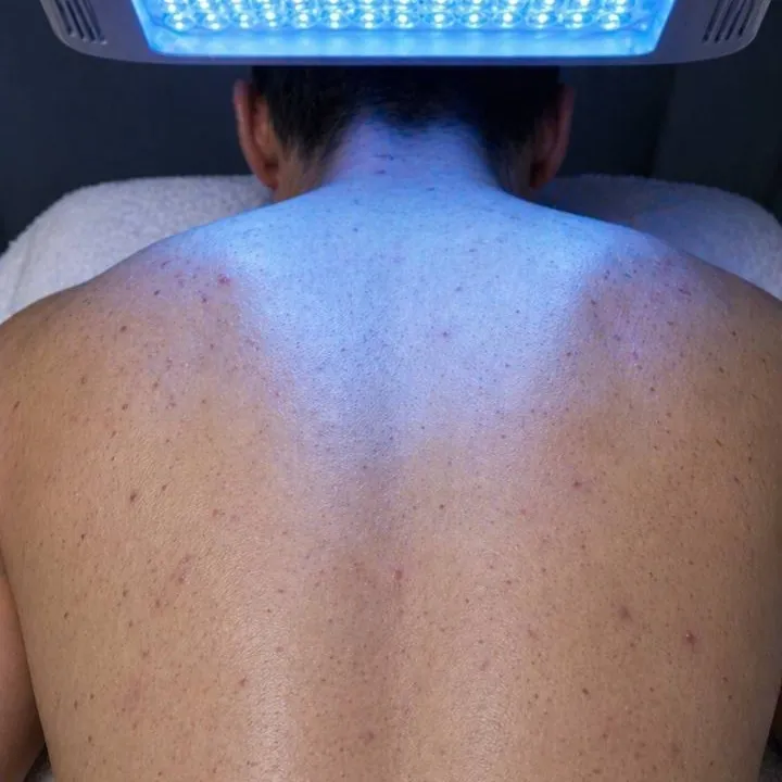 A blue LED panel positioned over a back during a treatment