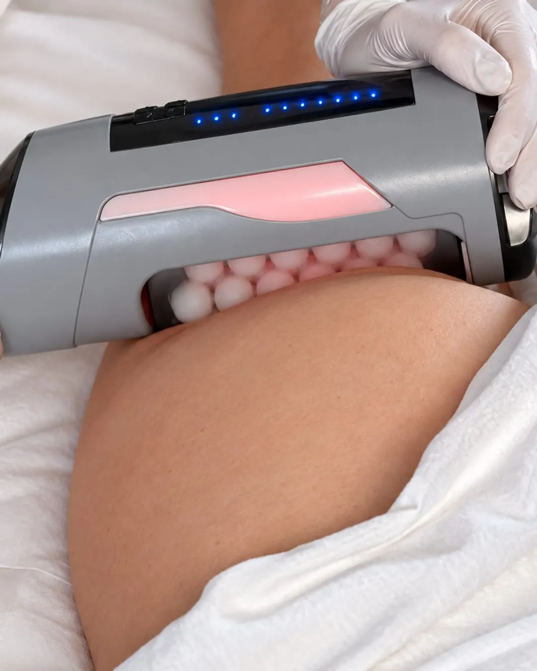 Endospheres compressive microvibration applied to the thigh at La Vilna