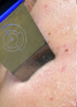 Acne Facial treatment