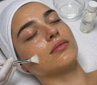 Strong chemical peel treatment