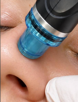 Hydradermabrasion treatment