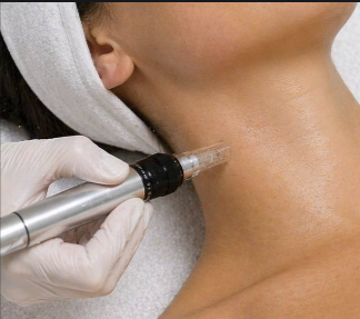 Neck microneedling treatment